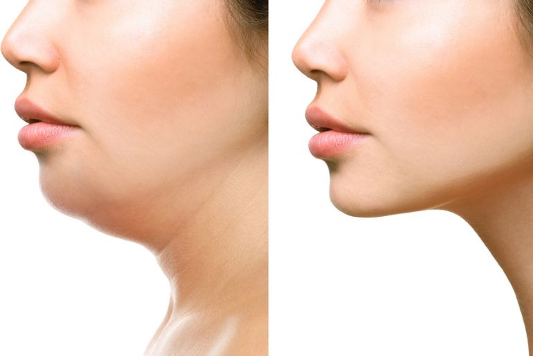 Double Chin Liposuction in Dubai